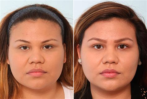 buccal fat removal norge|Buccal Fat Pad Removal .